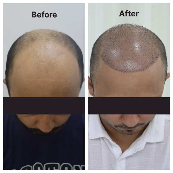 Hair Transplant result KOQ10